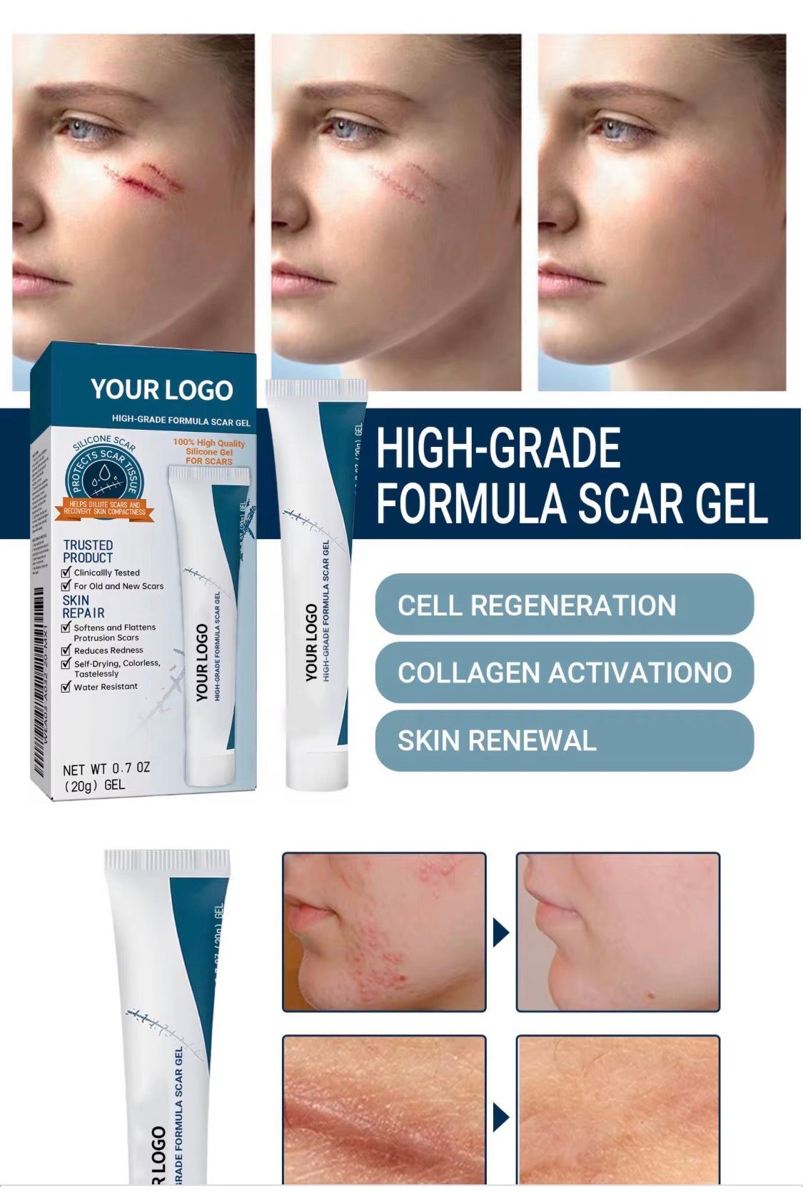 Scar removal gel