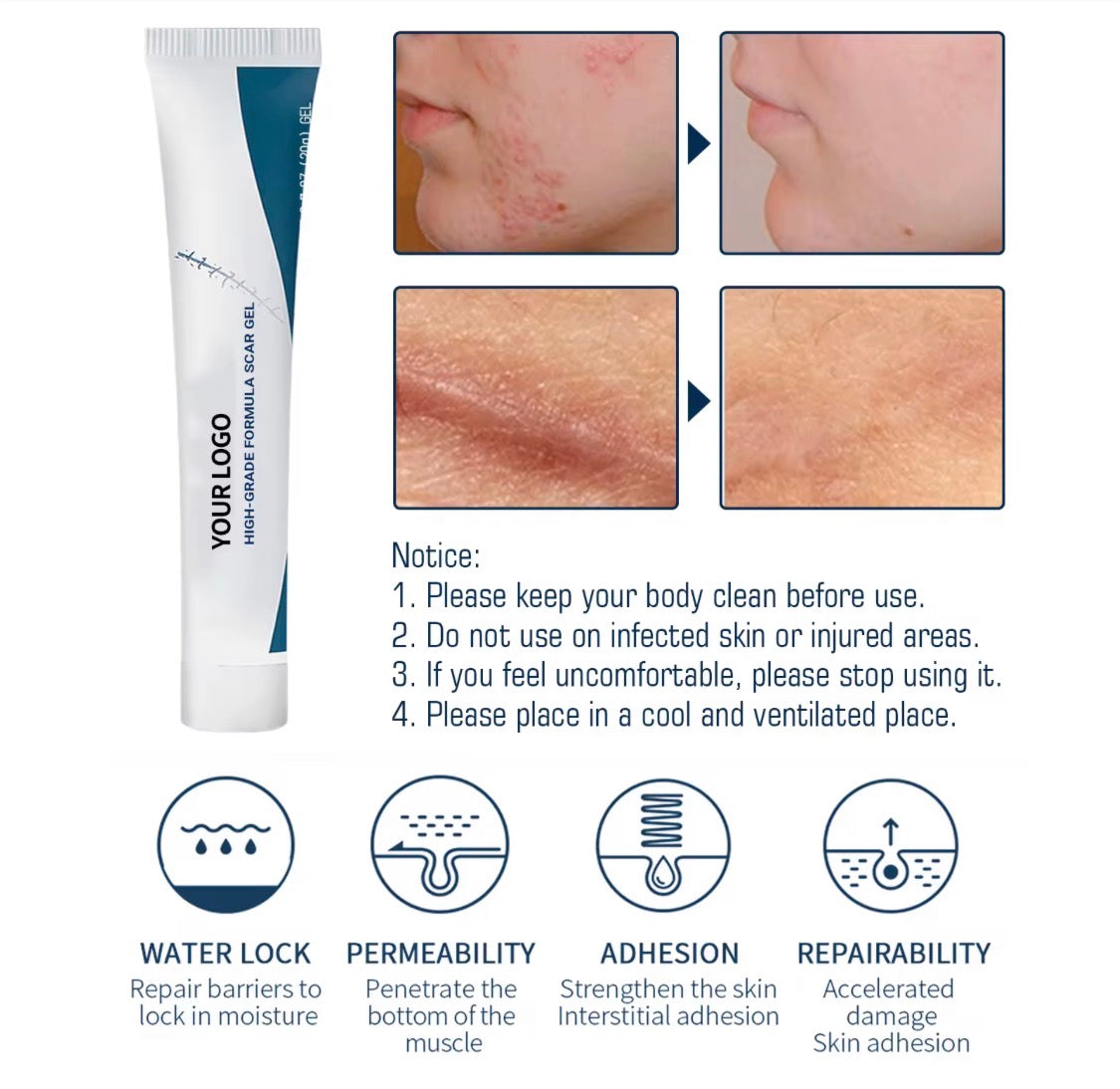 Scar removal gel