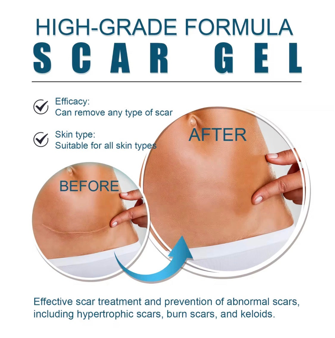 Scar removal gel