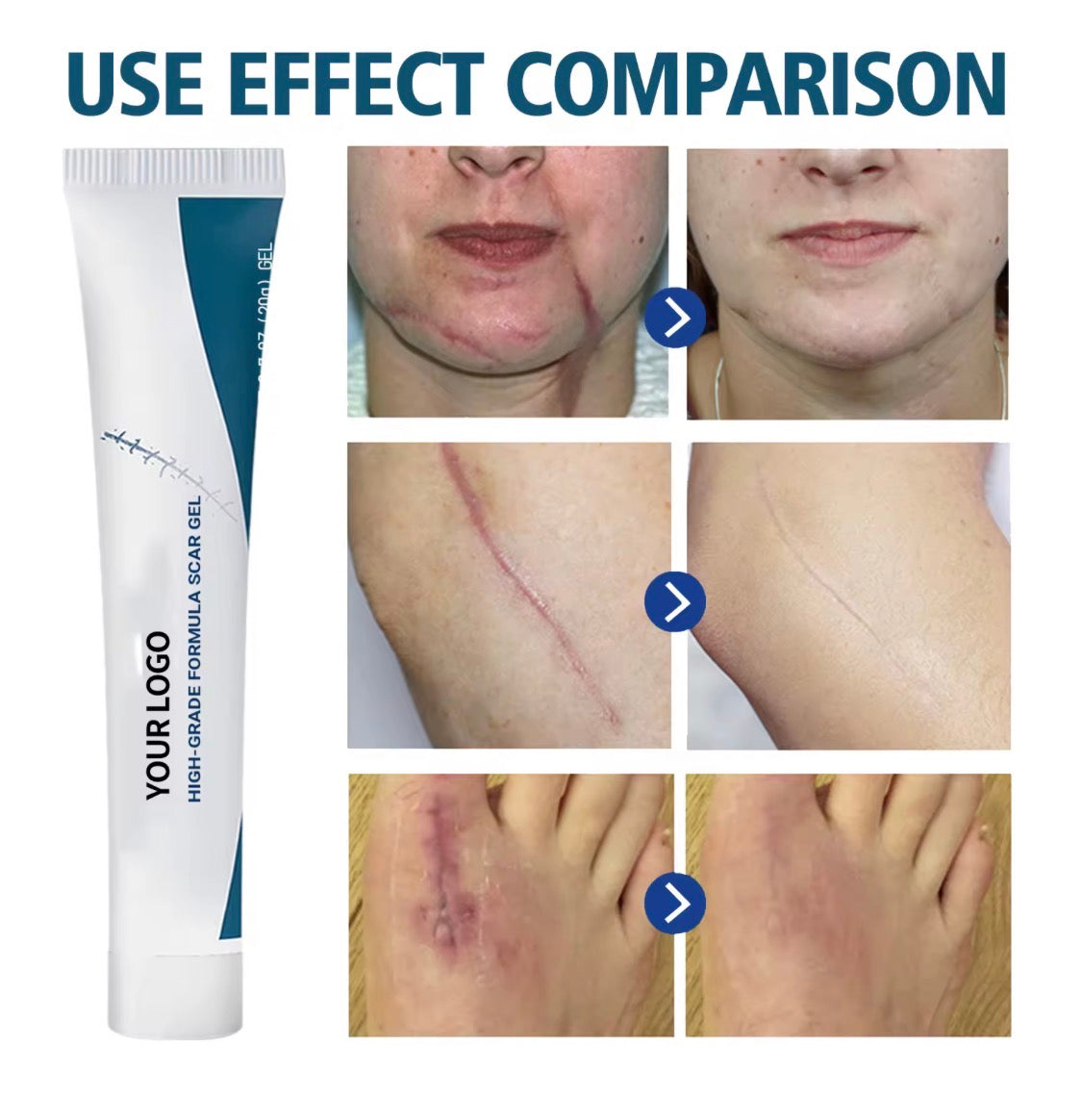 Scar removal gel