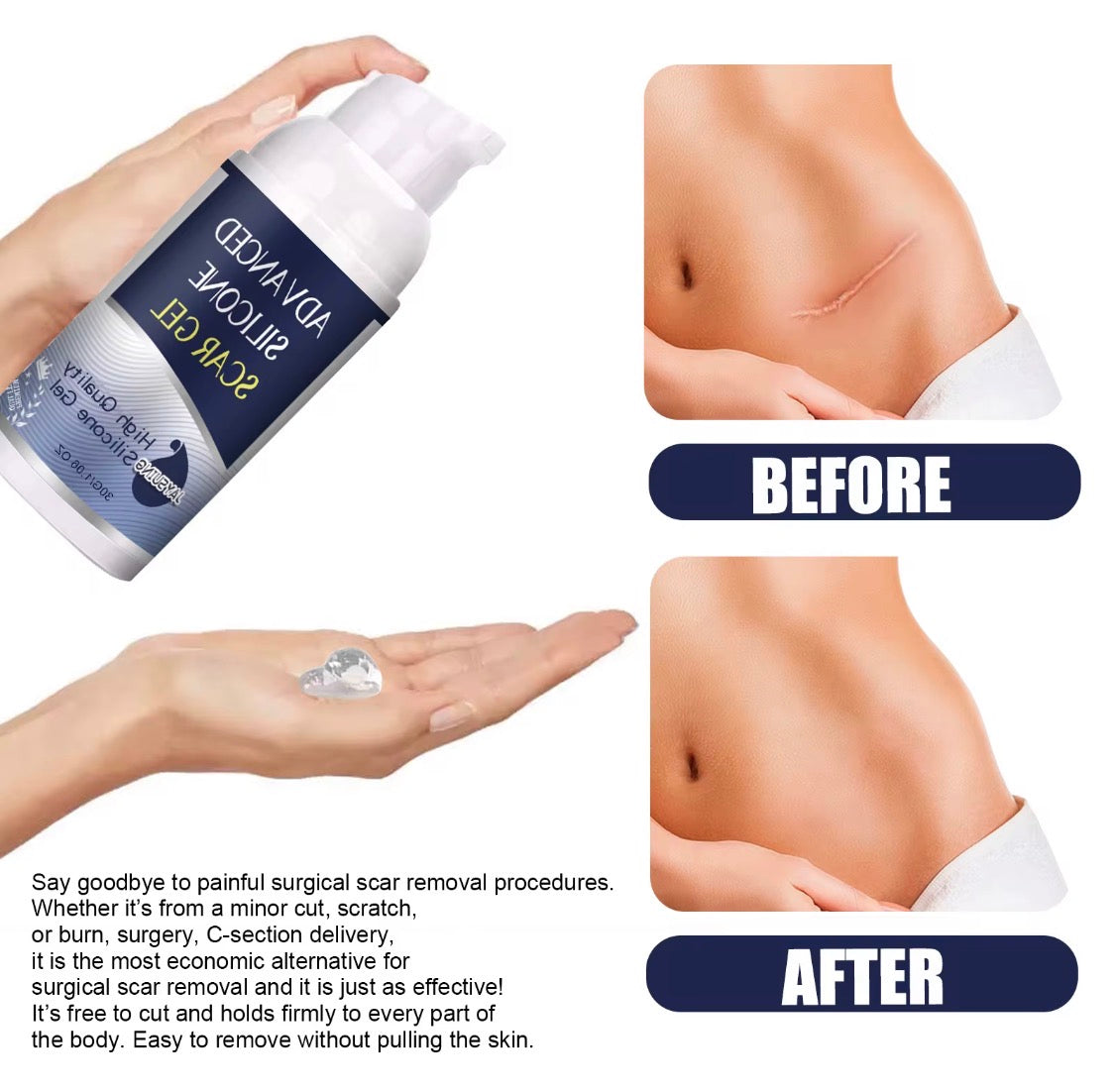 Medical-Grade Silicone Scar Gel for Keloids & Stretch Marks
